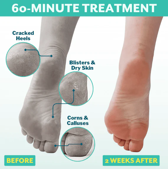 Patchology PoshPeel Foot Peel